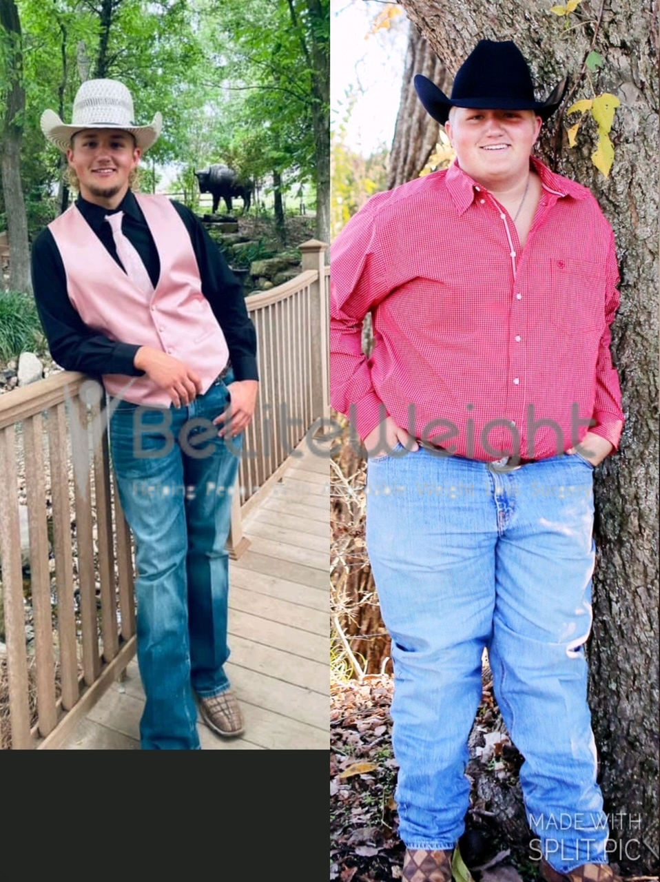 Sleeve Gastrectomy Before and After